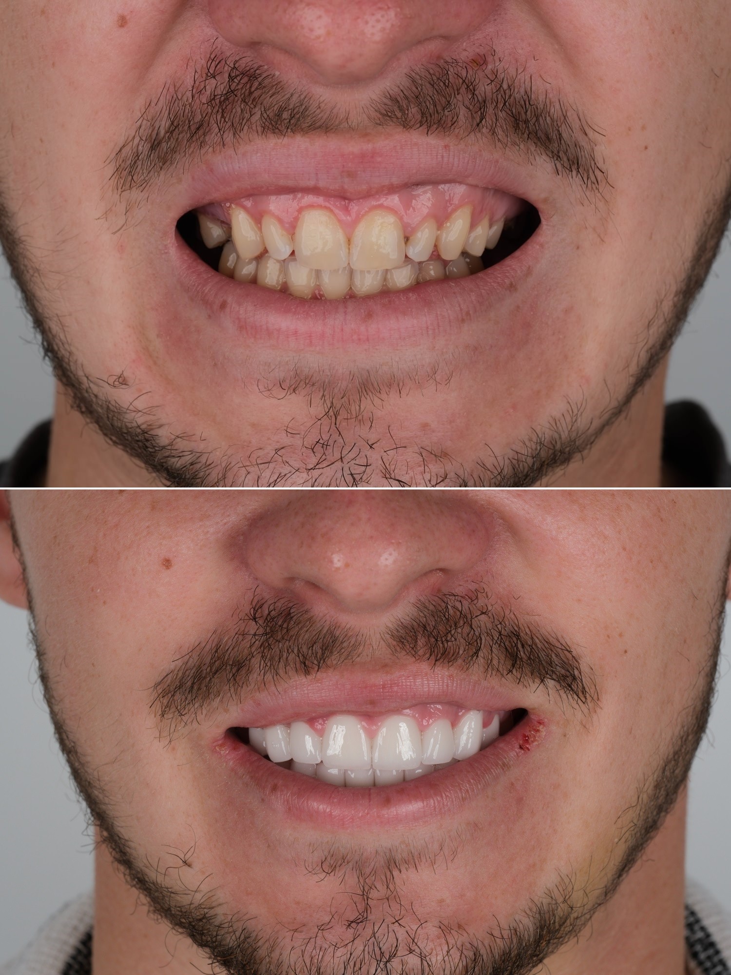 Smile Makeover-Behandlung mit 24 Zirkonkronen und 3 Implantaten