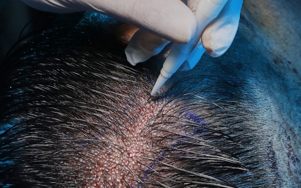 Unrasierte Haartransplantation