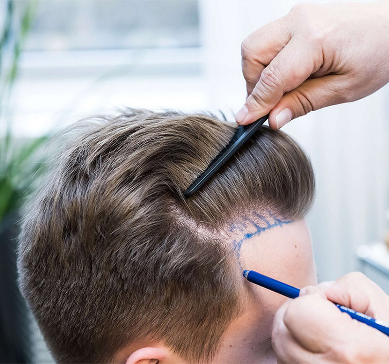 Was ist eine FUE-Haartransplantation? 