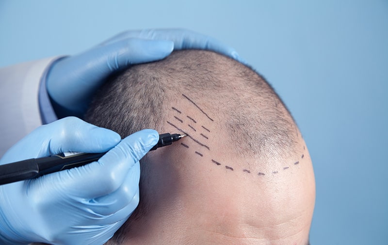 Haartransplantation mit Sedierung